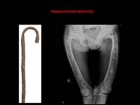 LOẠN SẢN XƠ XƯƠNG (fibrous dysplasia)